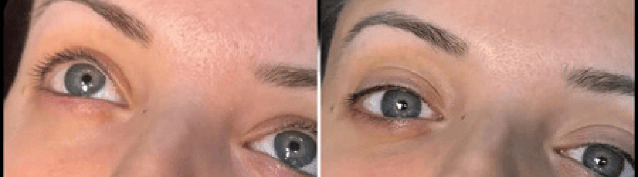 Dermal Fillers